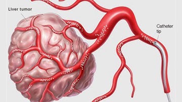 Interventional Oncology  │Unique Interventional Radiology