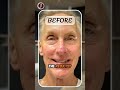 ✨ J Lift™ Instant Face-Lift | Non-Surgical Facelift in 30 Minutes ✨