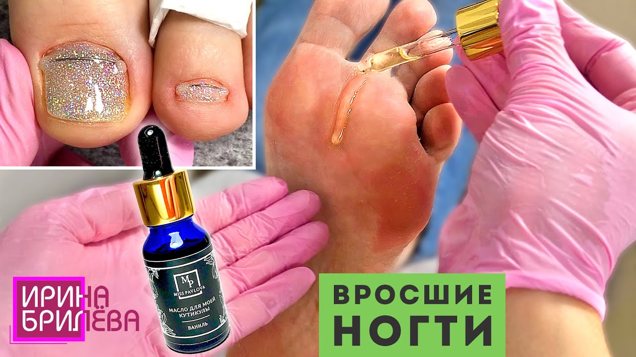 ВРОСШИЙ НОГОТЬ 🌸 Установка Титановой нити (NiTi) 🌸 ПЕДИКЮР 🌸 Ирина ...