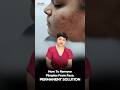 How to Remove Pimples from Face Permanently | Get Clear Skin Fast | Acne &amp; Scar Treatment #pimples