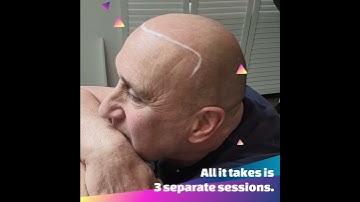 Scalp Micropigmentation (SMP)