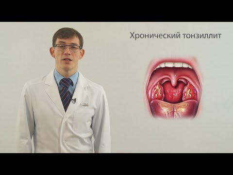 Хронический тонзиллит ч1 (боль в горле, запах изо рта)