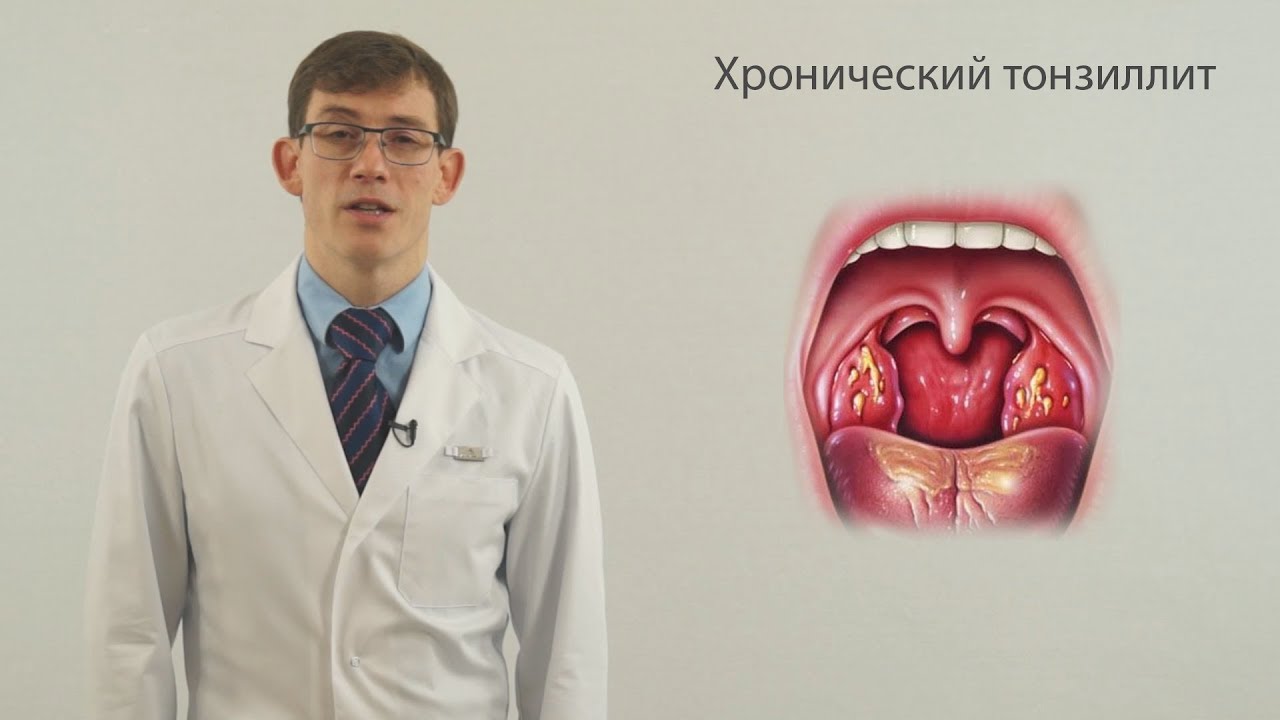 Хронический тонзиллит ч1 (боль в горле, запах изо рта)