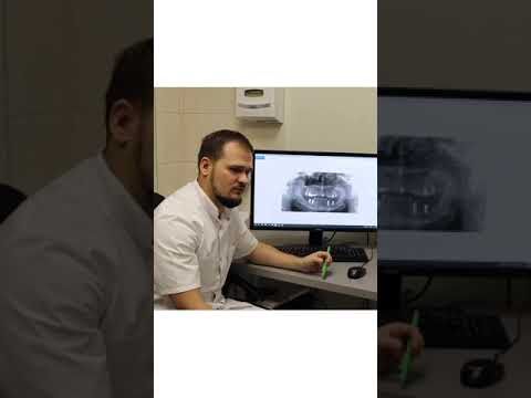 Что лучше, импланты или мост?