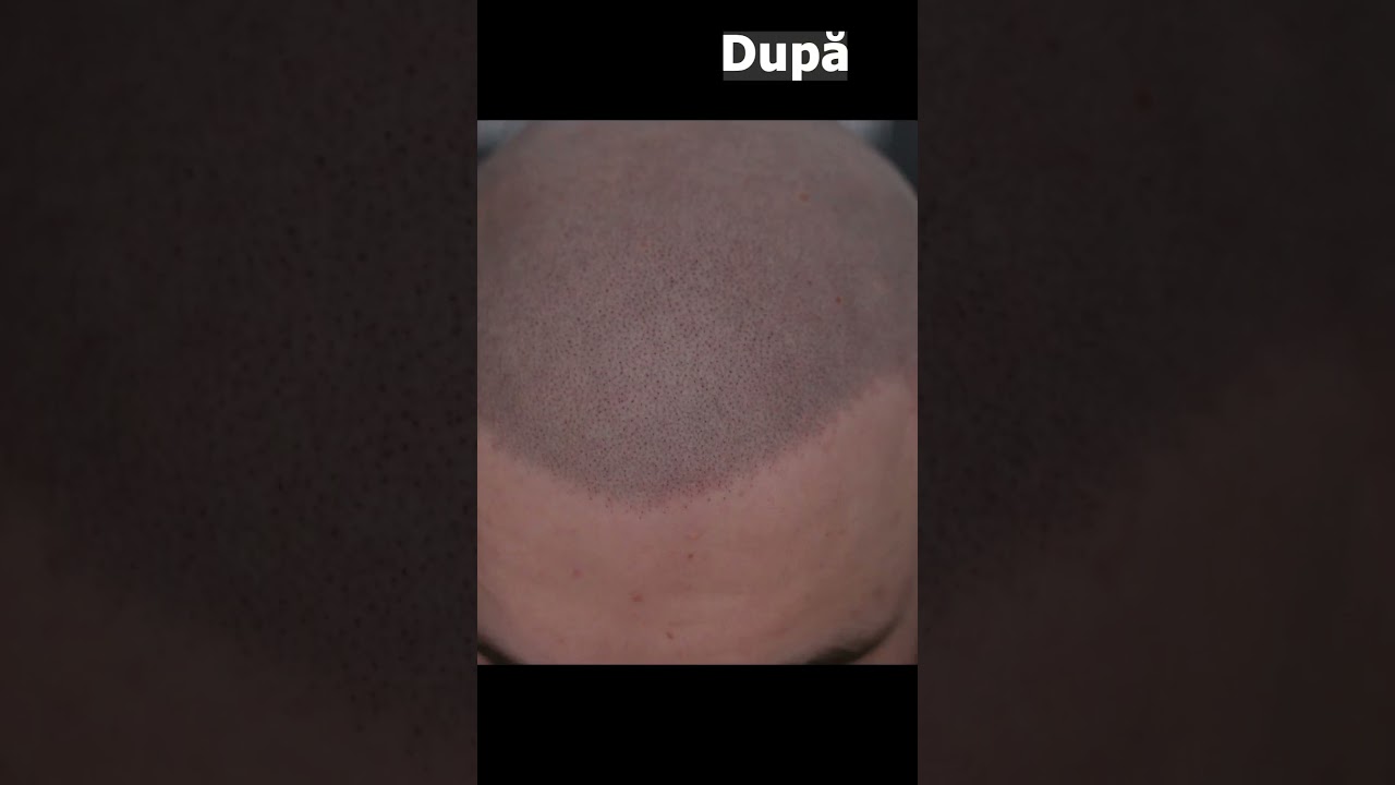 Solutie Chelie Micropigmentare Scalp 