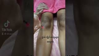 Knee whitening laser #aesthetic #dermatologist www.facebook.com/dermtalksbydrsuri