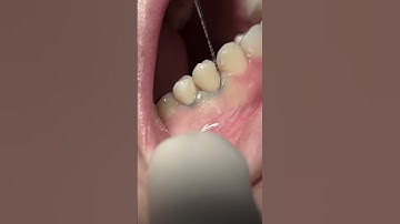 Class V composite restoration #dentist