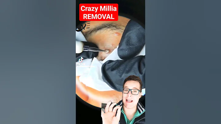 CRAZY HUGE MILIA REMOVAL - How To Get Rid of Milia #shorts