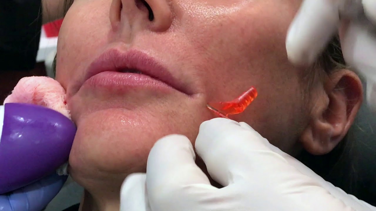 Lip Enhancement with Refyne + Cannulas by Dr. Weiner