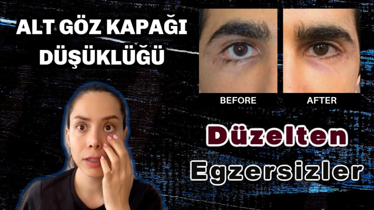 Exercises to Correct Dropped Lower Eyelid and Eye Asymmetry - YouTube