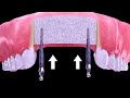 Cc phng php trng rng implant  dental implant methods