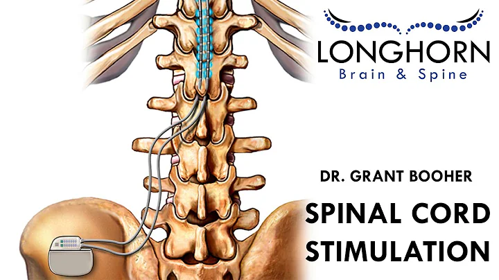 Longhorn Brain and Spine - Spinal Cord Stimulation
