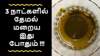 Themal skin disease I themal maraiya tips in tamil I themal poga tips in tamil I தேமல் மறைய