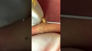 acne blackhead pimple satisfying blackheads pimpleremoval fyp  ID Video 7244105491100667162