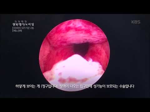 생로병사의 비밀 - 대수롭지 않게 여기고, 부끄러움 때문에 쉬쉬하는 고통.20190130