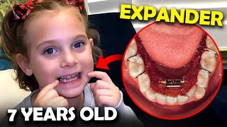 Getting an expander at 7 years old! Everything you need to know...