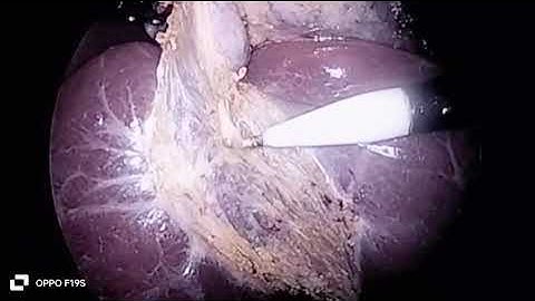 Hook dissection in laparoscopiccholecystectomy@dr vikrant singh chandail