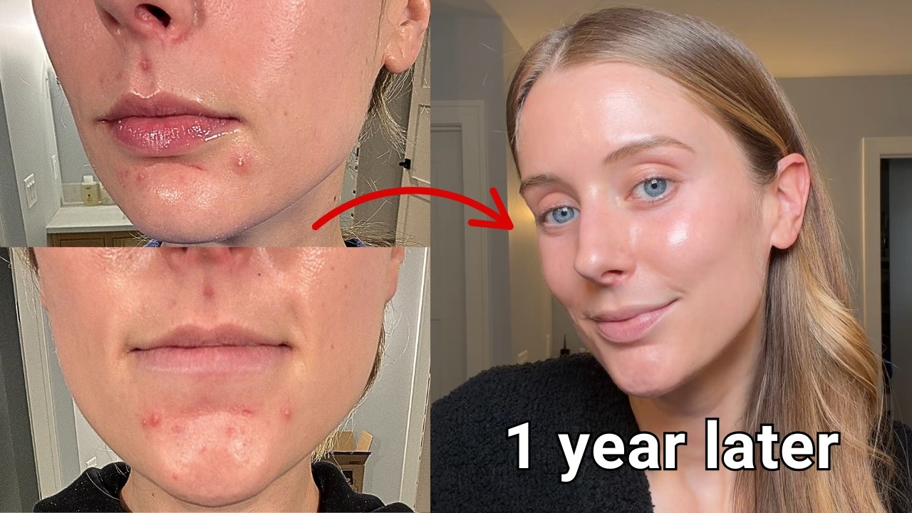 What Actually Helped My Oily, Acne Prone Skin in My 30’s