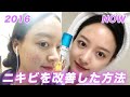 【ニキビ改善】私が克服した方法をご紹介します❤️【韓国スキンケア】