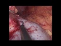 Lap left partial nephrectomy - HOW I DO IT!