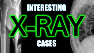 Interesting X-Ray Cases #xray #bones #radiology