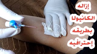 شاهد إزاله الكانيولا بأحترافيه_لتجنب إلتهاب وتصلب الوريد The cannula removed professionally