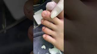 Lấy Khoé Chân Sâu Xuyên Nail Cà Mau Tập 250 Nails