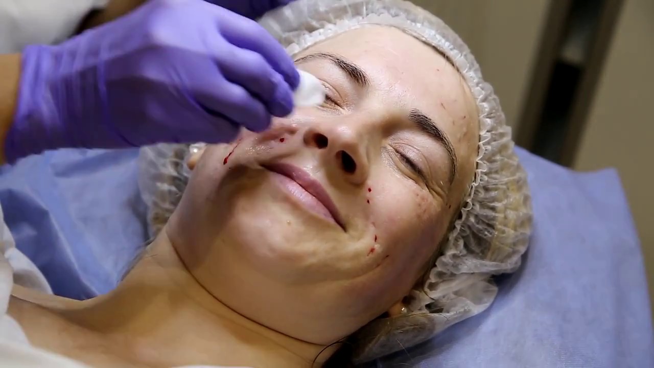 My Skin - Биоревитализация Evolution BH 0 8