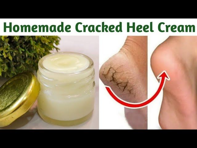 Get your feet ready for summer with this DIY Cracked Heel Cream | Homemade  foot cream, Cracked heel remedies, Diy foot cream