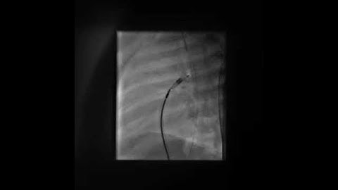 PDA device closure   Exposure of the PA end of the device