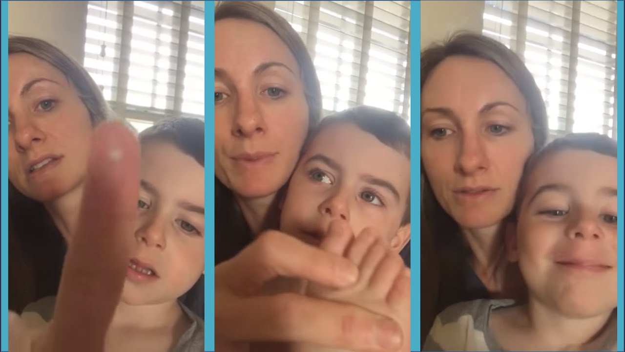 Long-term Eczema Management: Amount of steroid used on the Aron Regimen