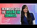 Caso de Diseño de Sonrisa Dientes Pequeños y Separados #storytime