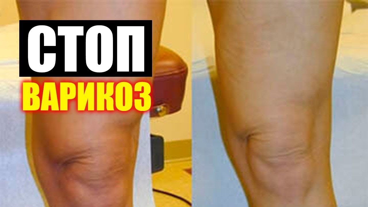 Варикоз Народные Средства Яблочный Уксус. Лечение Варикоза В Домашних ...