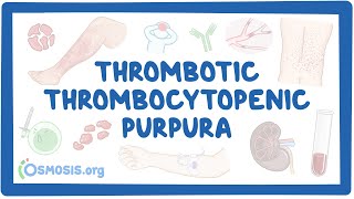 Thrombotic thrombocytopenic purpura (NORD)