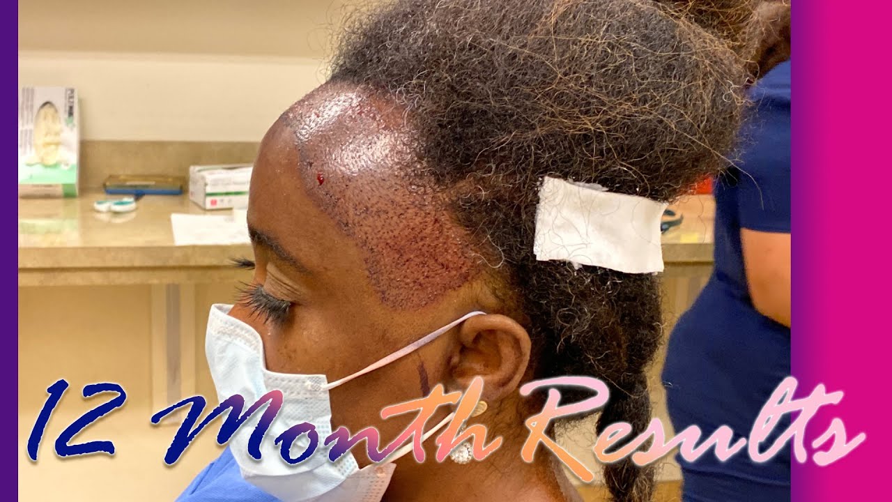 Ashley s Amazing 1 Year Hair Transplant Results For Black Women YouTube Ashley s Amazing 1 Year Hair Transplant Results For Black Women YouTube