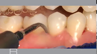 How To Use Perisolv Against Periodontitis, And Mucositis.
