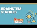 Brainstem stroke mnemonics memorable neurology lecture 15