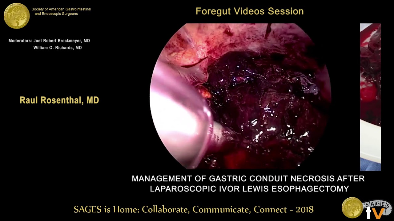 Management Of Gastric Conduit Necrosis After Laparoscopic Ivor Lewis Esophagectomy Youtube