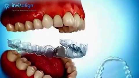 Invisalign Việt Nam - Niềng răng không mắc cài Invisalign