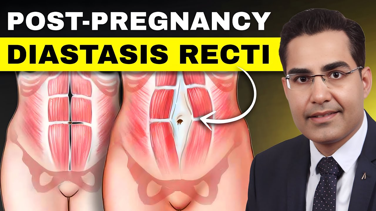 What is Diastasis recti? Post Pregnancy Tummy Tuck Surgery India