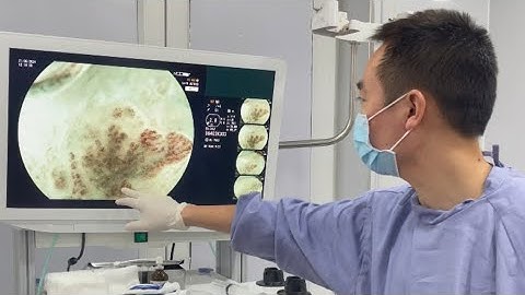 Chỉ định can thiệp sớm ung thư thực quản người bệnh