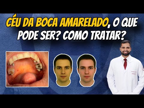 Céu da boca amarelado, o que pode ser? Como tratar? #drfranciscodeassisjr #estomatologia