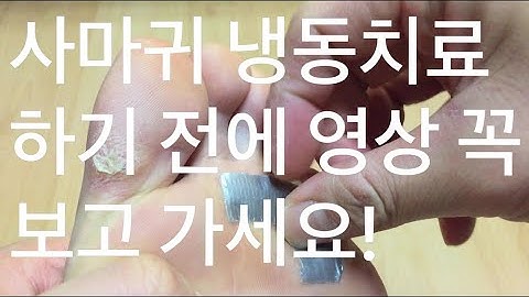 사마귀 냉동치료 하기 전에 영상 꼭 보고 가세요!