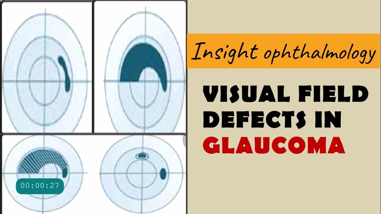 field-defects-in-glaucoma-arcuate-paracentral-nasal-step-temporal