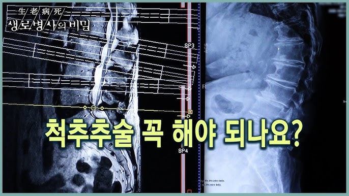 허리 수술을 하면 안되는 걸까요? 허리수술 총정리! 5