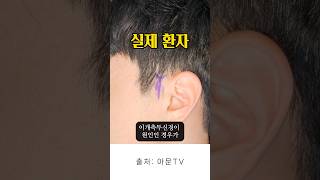 관자놀이 두통 수술 후기 (귀 주변 통증 이개측두신경 신경감압술 편두통 군발두통 주사 치료 서울 성형외과 병원 migraine surgery seoul korea)[아문TV]
