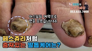 층져있는 발톱케어!!! #대구내성발톱 #대구무좀발톱 #문제성발 #fungal #toenails