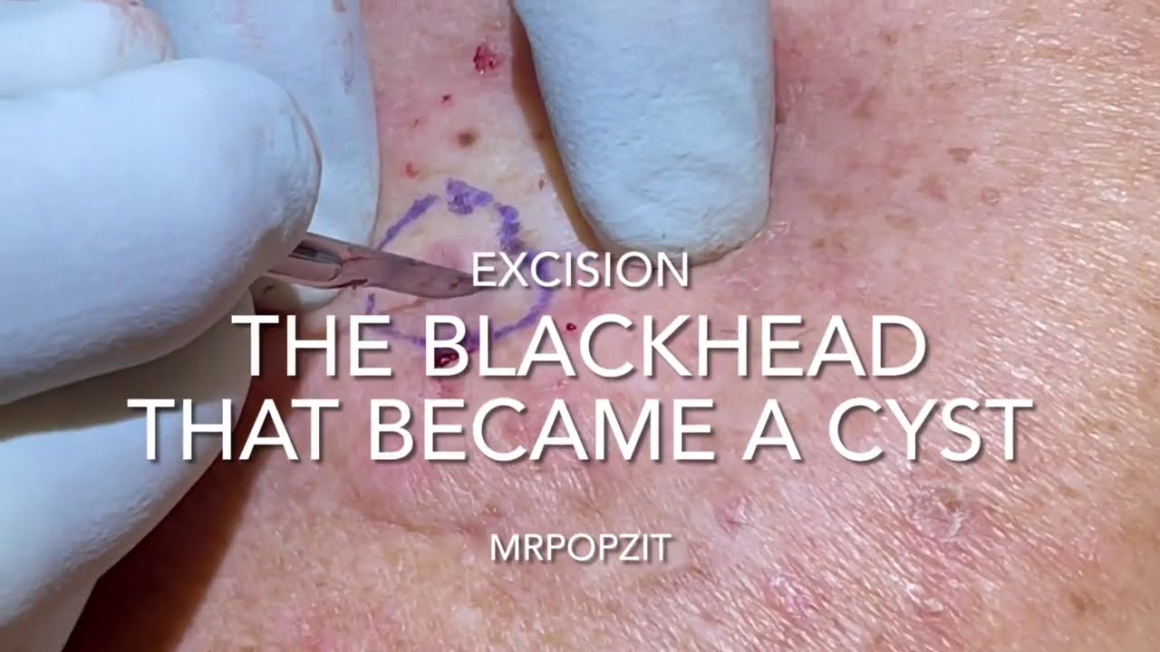 Ingrown Hair Cyst Armpit