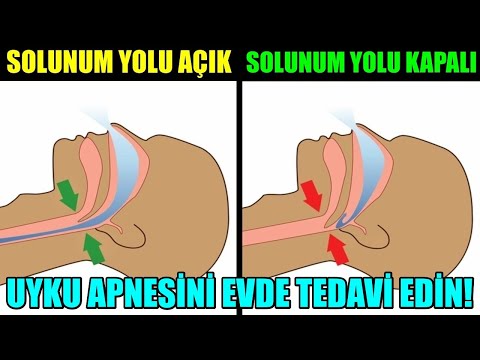 UYKU APNESİ NEDENLERİ VE EVDE TEDAVİ YÖNTEMLERİ