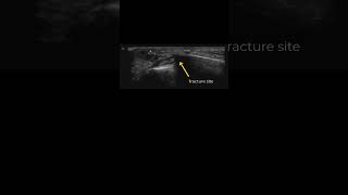 Metacarpal Fracture #POCUS Guided Ulnar Nerve Block and Reduction #pocus